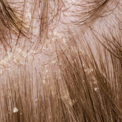 7 Best Ways to Prevent Flakes and Dandruff