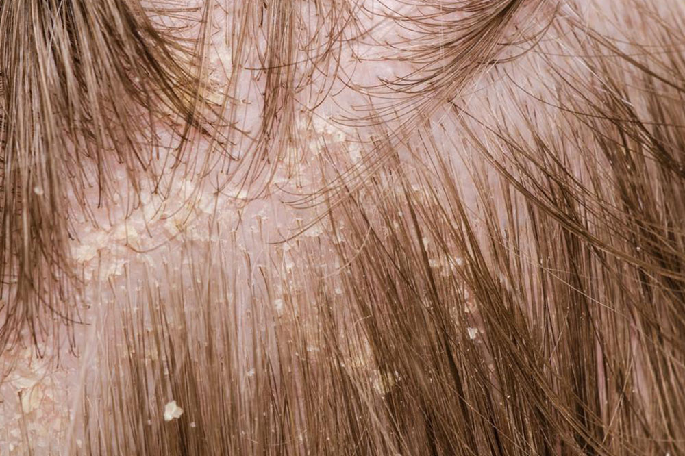 7 Best Ways to Prevent Flakes and Dandruff