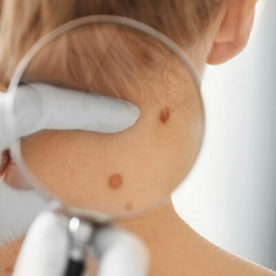 Be Aware of the Common Melanoma Risk Factors