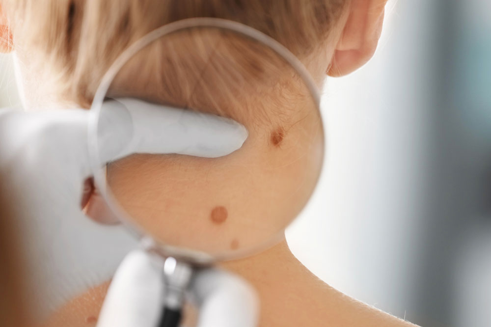 Be Aware of the Common Melanoma Risk Factors