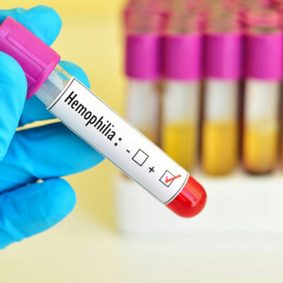 What Are the Various Ways of Treating Hemophilia