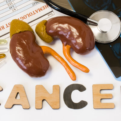 5 Early Signs of Kidney Cancer