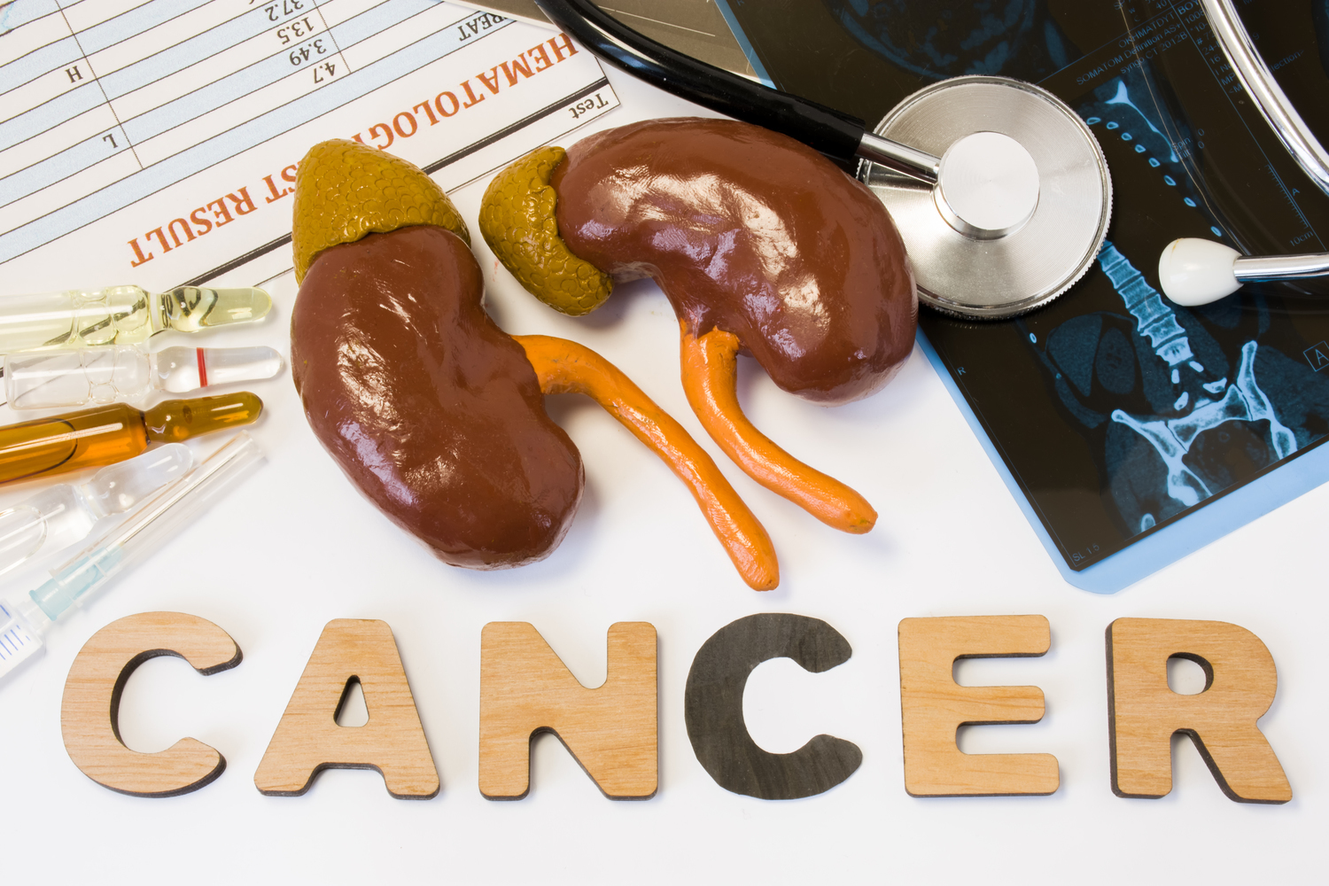 5 Early Signs of Kidney Cancer